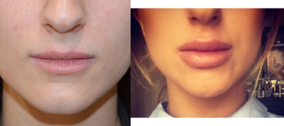 Lip Fillers before and after photo