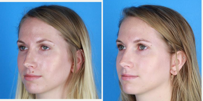 Mole Removal before and after photo