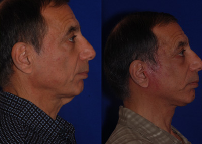 Neck Lift before and after photo