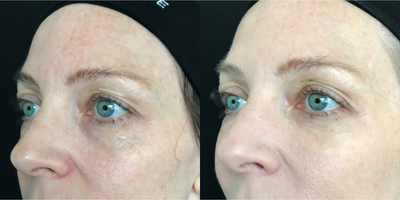 Restylane Refyne before and after photo