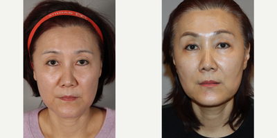 Cheek Lift before and after photo