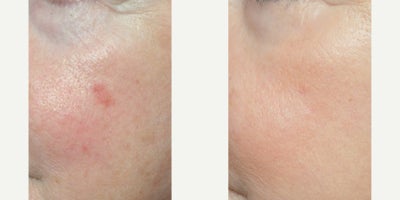 Chemical Peel before and after photo