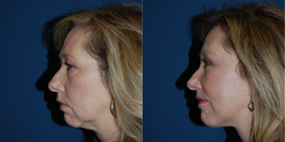 Chin Implant before and after photo