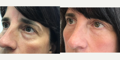 Dermal Fillers before and after photo