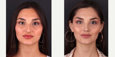 Rhinoplasty before and after photo