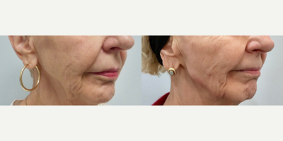 Bellafill before and after photo