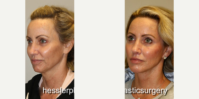 Chin Implant before and after photo