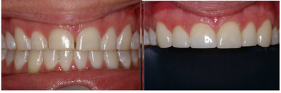 Porcelain Veneers before and after photo