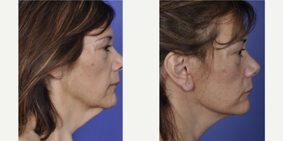 ThermiTight before and after photo
