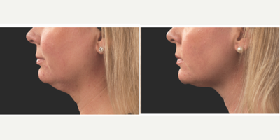 CoolSculpting before and after photo