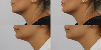CoolSculpting before and after photo