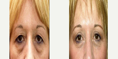 Eyelid Surgery before and after photo