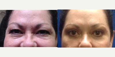 Eyelid Surgery before and after photo
