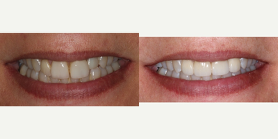 Porcelain Veneers before and after photo