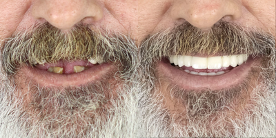 Porcelain Veneers before and after photo