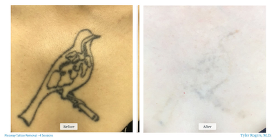 Tattoo Removal before and after photo