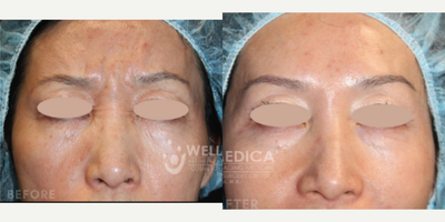 Botox before and after photo