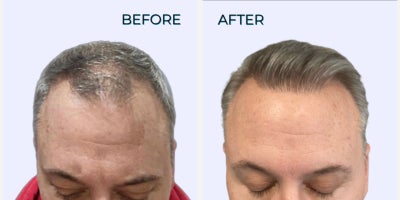 FUE Hair Transplant before and after photo