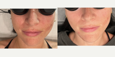 IPL before and after photo