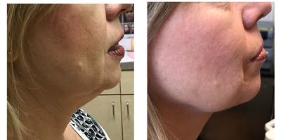 Kybella before and after photo