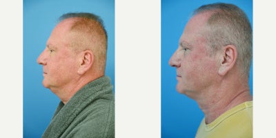 Liposuction before and after photo