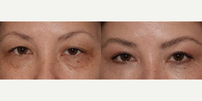 Ptosis Surgery before and after photo