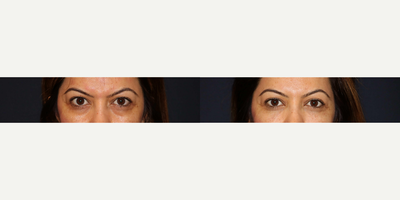 Eyelid Surgery before and after photo