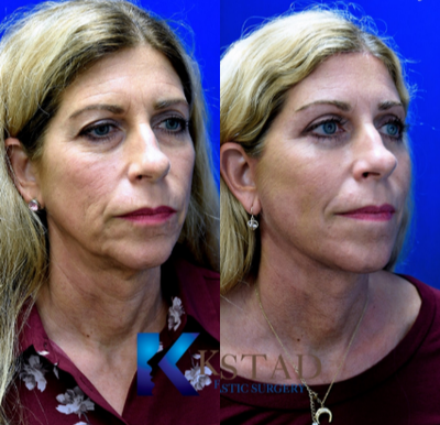 Facelift before and after photo
