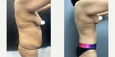 Mommy Makeover before and after photo