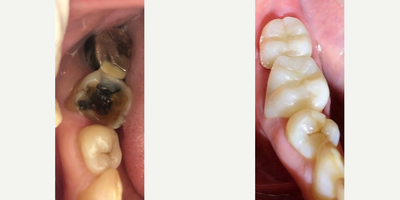 Dental Crown before and after photo