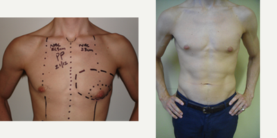 Gynecomastia Surgery before and after photo