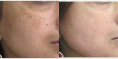 Laser Resurfacing before and after photo