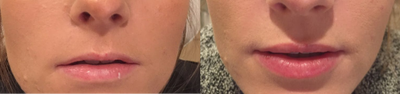 Lip Fillers before and after photo