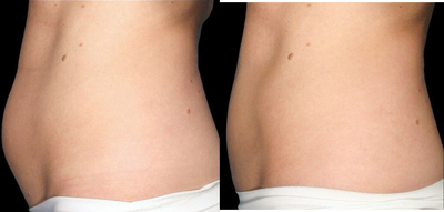 CoolSculpting before and after photo
