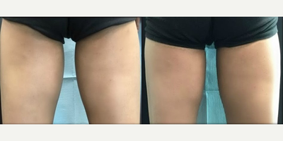 CoolSculpting before and after photo