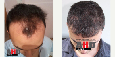 Hair Transplant before and after photo