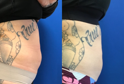 Kybella before and after photo