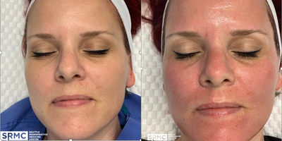 Microneedling RF before and after photo
