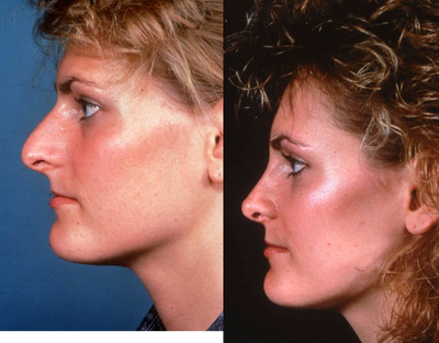 Rhinoplasty before and after photo