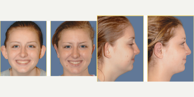 Ear Surgery before and after photo
