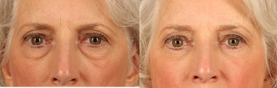 Eyelid Surgery before and after photo