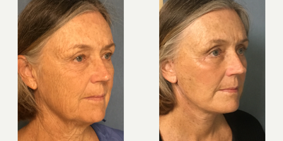 Facelift before and after photo