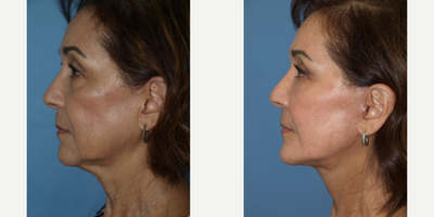 Facelift before and after photo