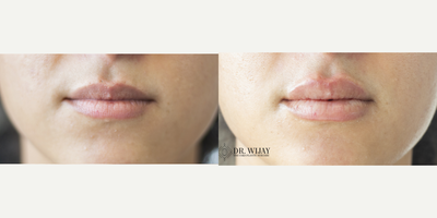 Lip Fillers before and after photo
