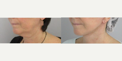 Neck Lift before and after photo