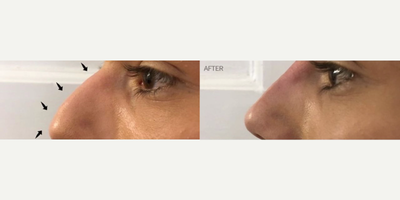 Nonsurgical Nose Job before and after photo