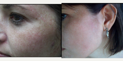 PRP Injections before and after photo