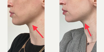 Radiesse before and after photo