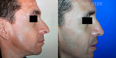 Rhinoplasty before and after photo