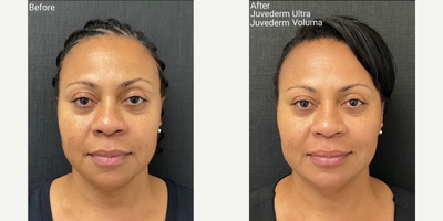 Voluma before and after photo